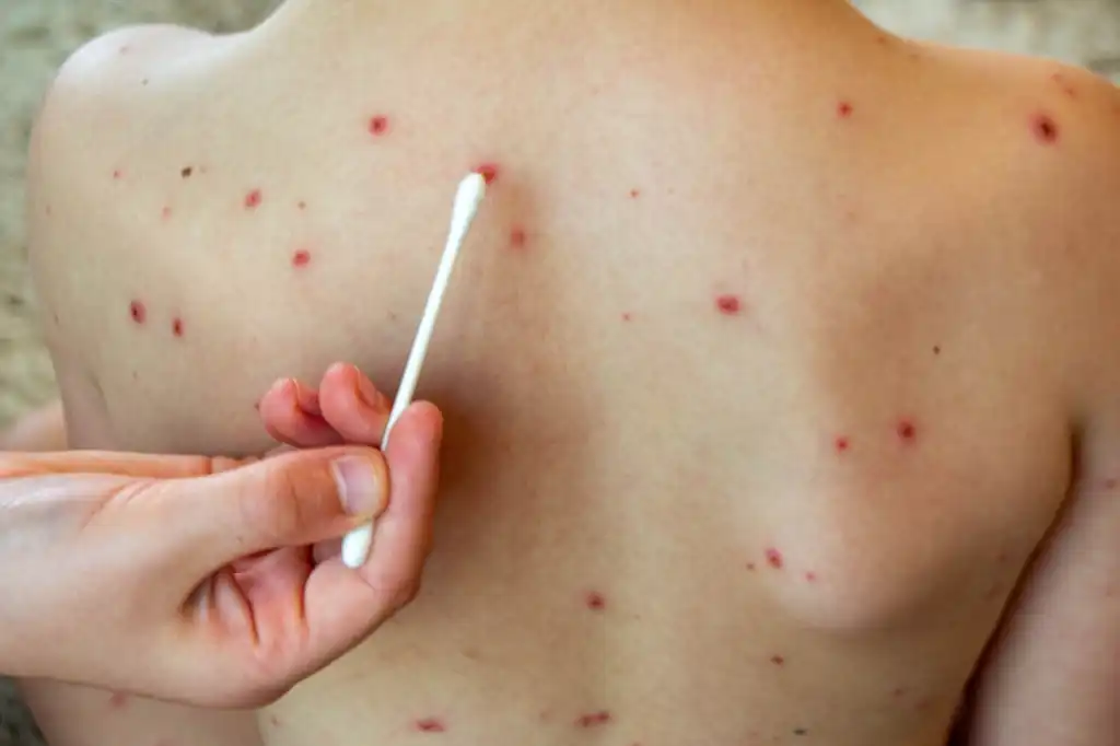 Ssa emite aviso preventivo de viaje por brotes de sarampión en EE.UU. y Canadá